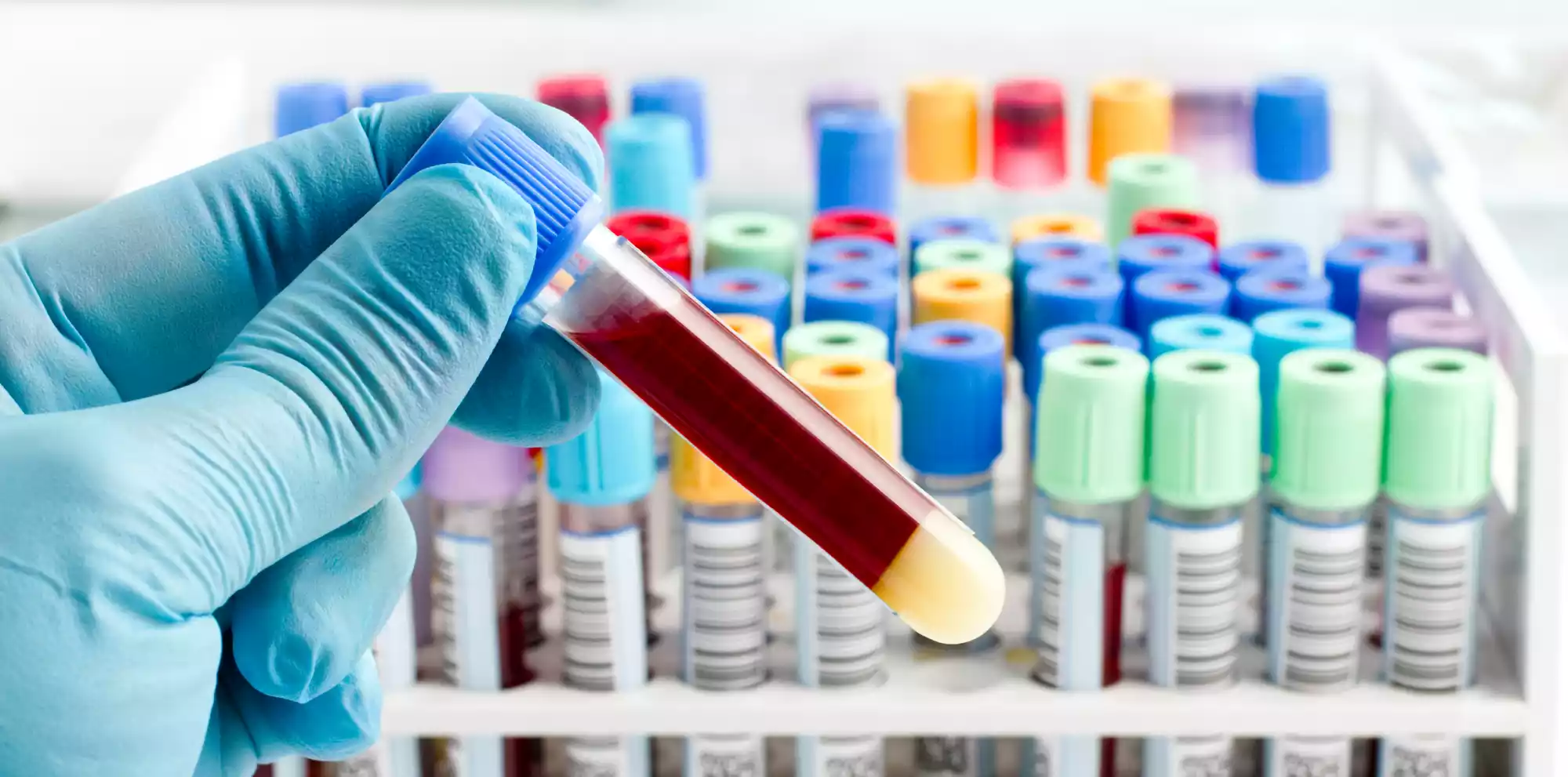 Researchers at KAUST and the University of Oxford have developed a blood-based sensor to detect three forms of a protein linked to Parkinson’s disease.