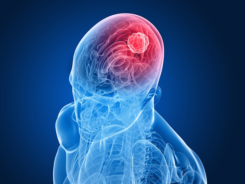 وێنەی کەسێک شێرپەنجەی مێشکی هەیە