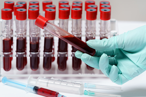 پشکنینی خوێن یارمەتیی زوو دەستنیشانکردنی نەخۆشییەکان دەدات